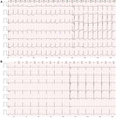 A case report on pheochromocytoma mimicking as fulminant myocarditis—a diagnostic challenge
